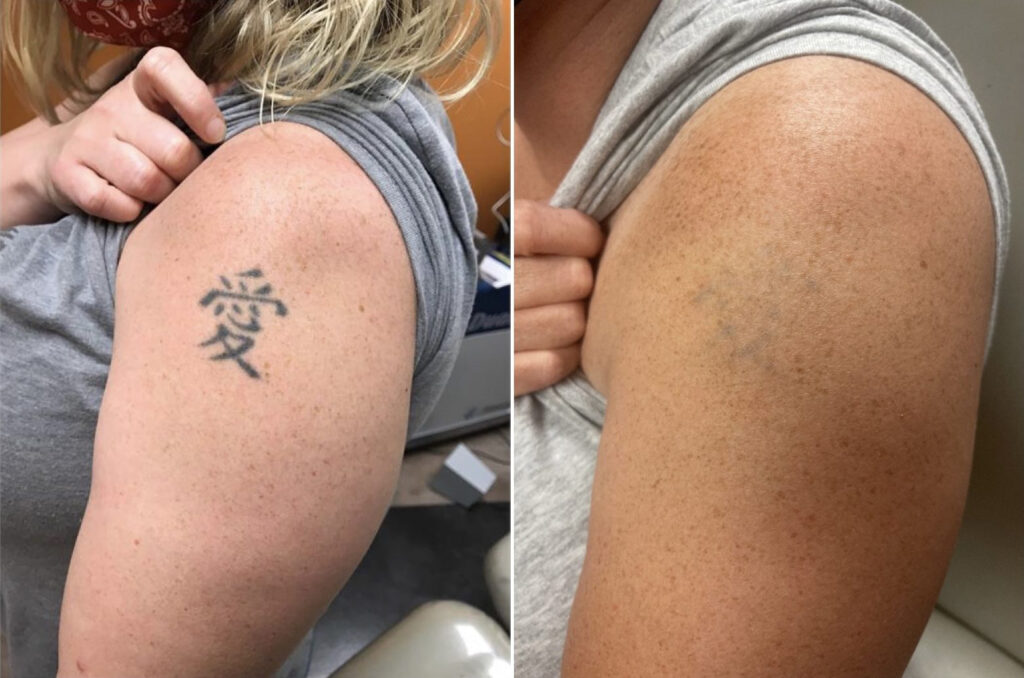Inkoff Hawaii - PicoSure Tattoo Removal Receives FDA Approval