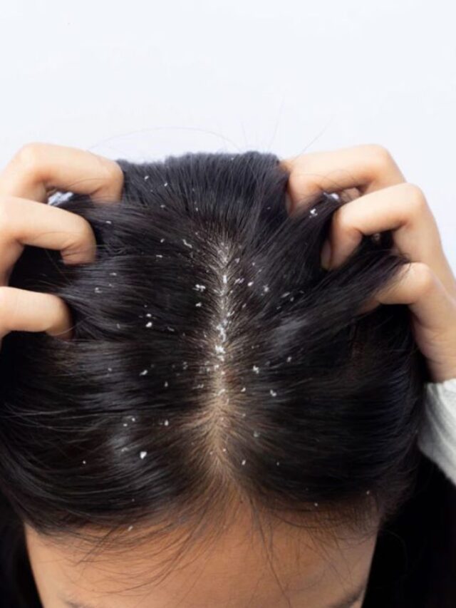 This one thing will control dandruff, the method is easy